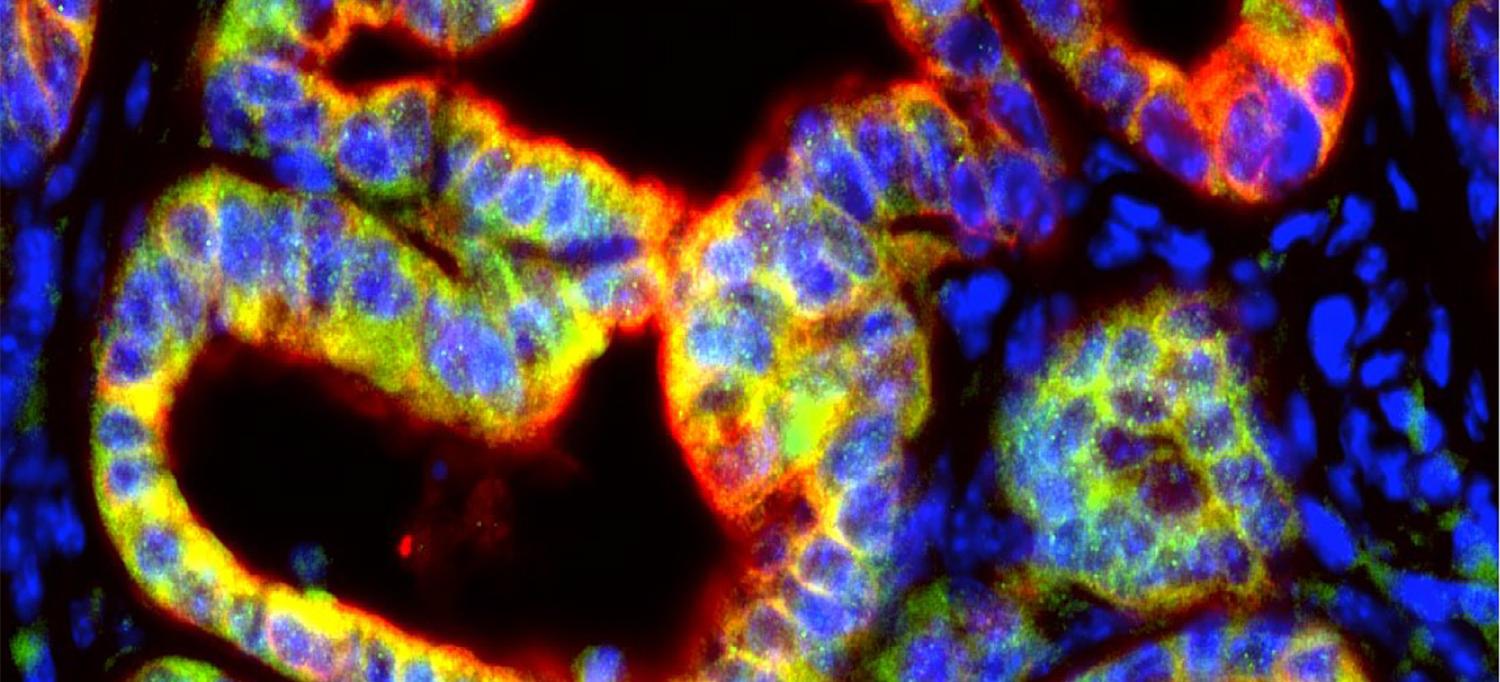 Cancer Cells Secrete Signal To Turn Off Immune System Attack