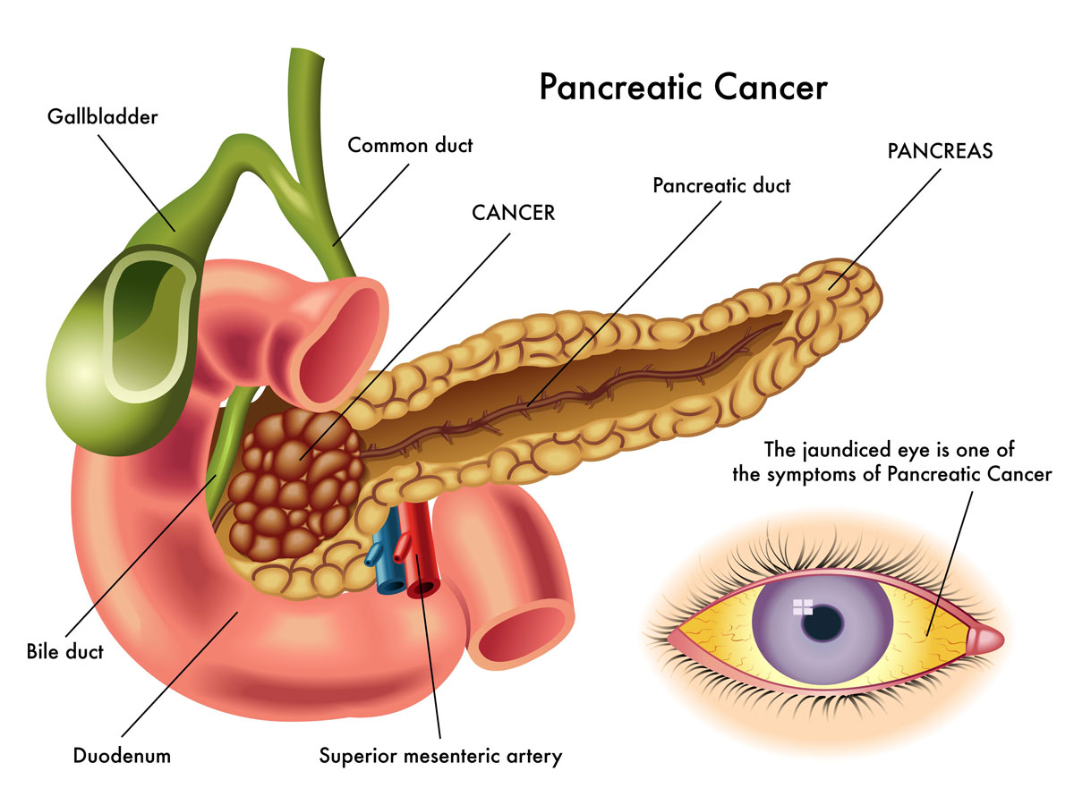 What Is A Pancreas Cancer Test