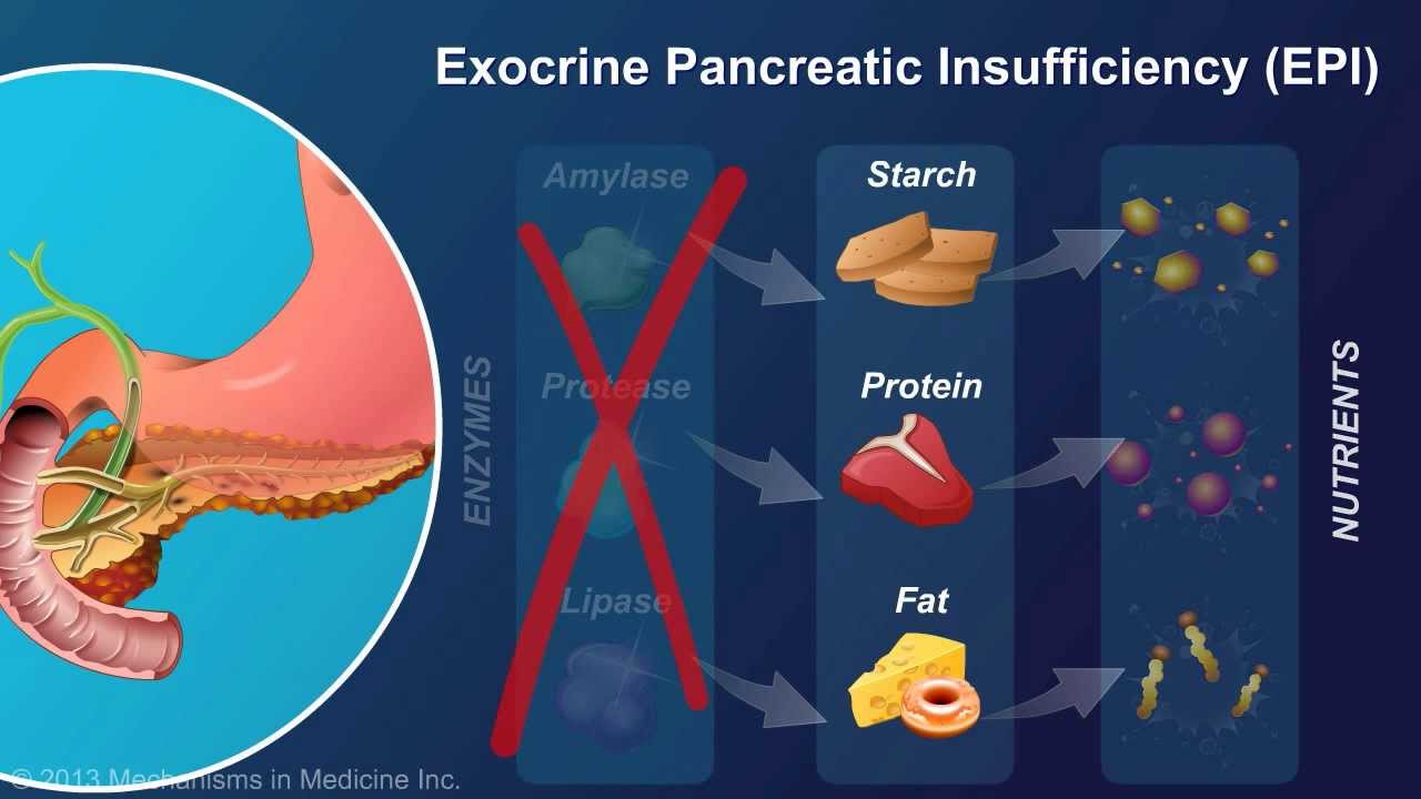Pancreatic insufficiency