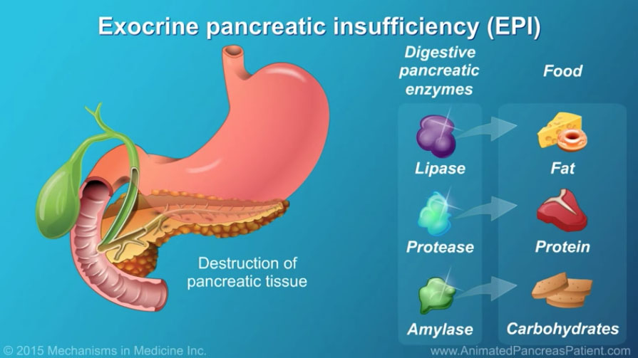 10 Symptoms of exocrine pancreatic insufficiency (EPI) You Should Never Ignore